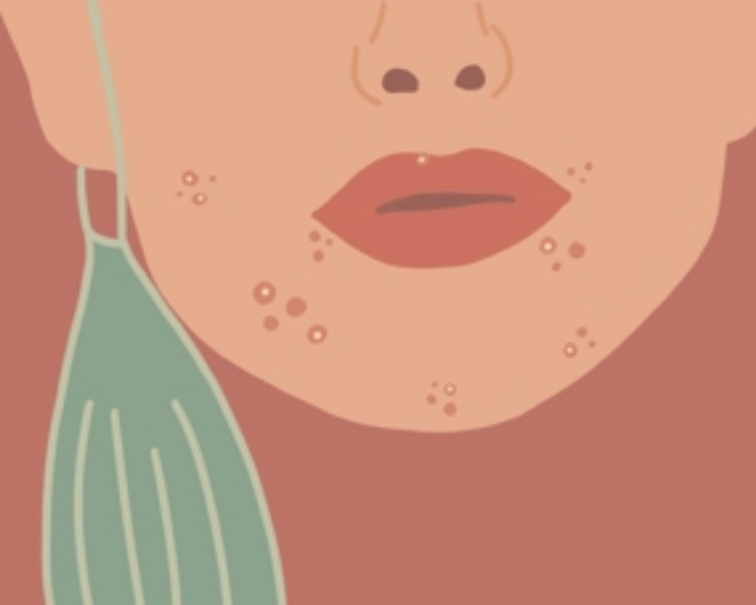 What causes maskne in the first place?